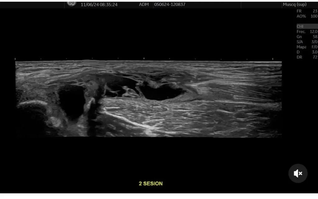 Ecografía Musculoesquelética